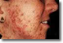 Voorbeeld van acne