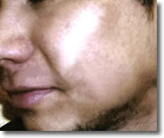 Acne littekens na microdermabrasie behandeling