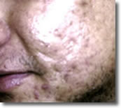 Acne littekens voor microdermabrasie behandeling