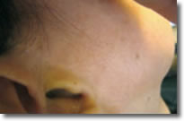 Litteken na microdermabrasie behandeling