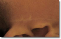 Litteken voor microdermabrasie behandeling