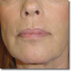 Na een behandeling mesotherapie