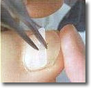 Nagelbeugel