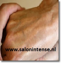Verwijderen pigmentvlekken op de hand - na