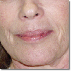 Voor een behandeling mesotherapie