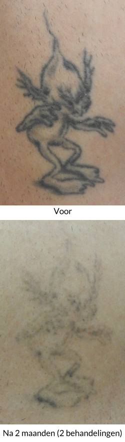 Tattoo verwijderen met laser