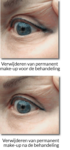 Verwijderen permanent make-up Verwijderen permanent make-up