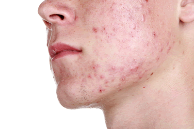 Acne bij mannen Acne bij mannen
