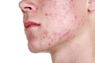 Acne bij mannen