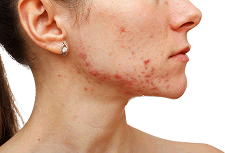 Acne behandeling Acne behandeling