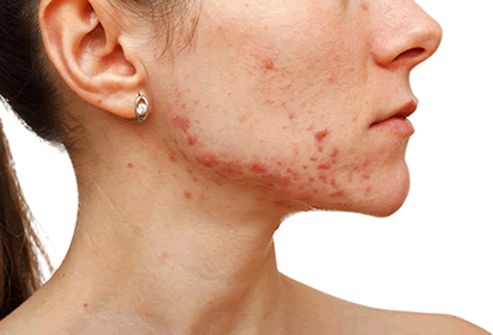 Acne behandeling