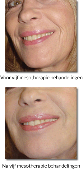 Voor en na een mesotherpie behandeling