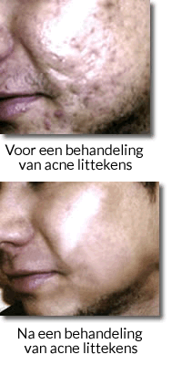 Acne littekens voor en microdermabrasie behandeling