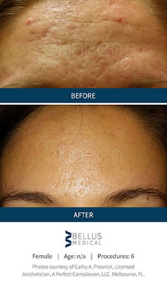 SkinPen before en after