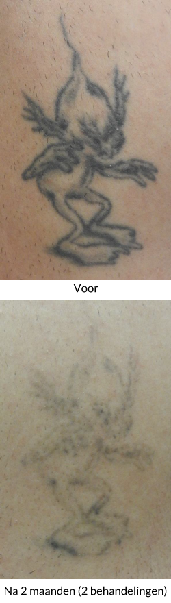 Tattoo verwijderen met laser Tattoo verwijderen met laser